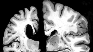 ultrasons contre alzheimer