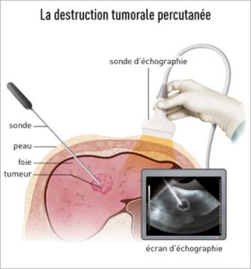 sonde échographique